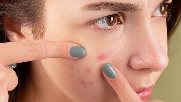 Ilustrasi: Kulit berjerawat bisa iritasi jika diobati pakai pasta gigi