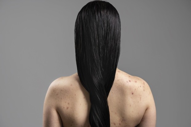 Body acne, jerawat badan, jerawat