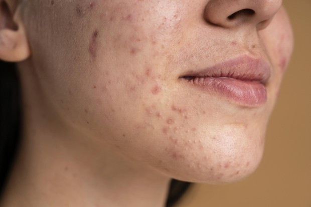acne skin (sumber : freepik)