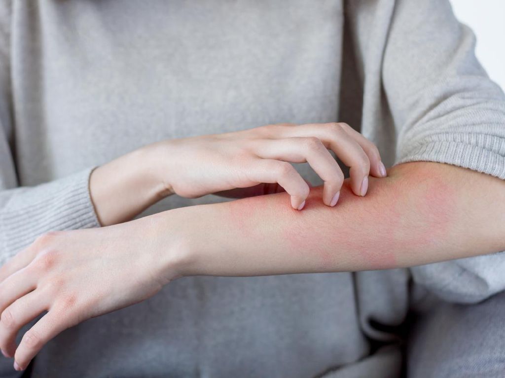 Mengenal Alergi: Jenis, Gejala, hingga Cara Mencegahnya