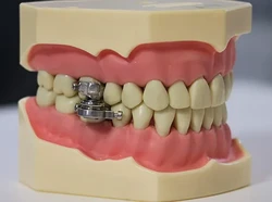 Alat Diet Mengandung Magnet, Dipasang di Gigi Supaya Tak Bisa Makan Banyak