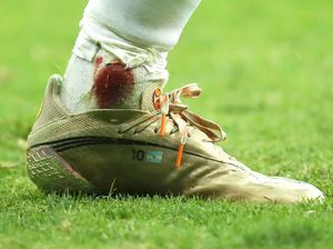 Copa America 2021: Kaki Lionel Messi Dihajar Sampai Berdarah-darah! Copa America 2021: Kaki Lionel Messi Dihajar Sampai Berdarah-darah!