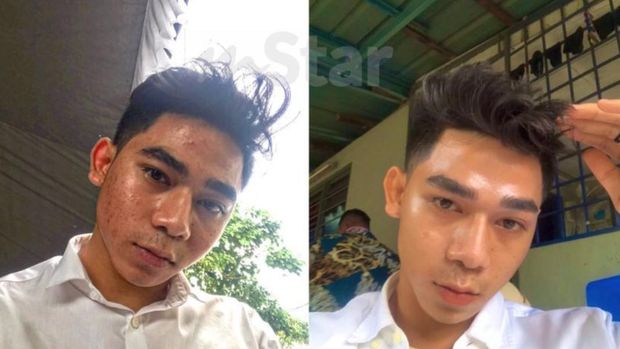 Transformasi wajah pria jerawatan viral