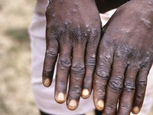 Gejala Cacar Monyet Dilaporkan Mirip Infeksi Menular Seksual