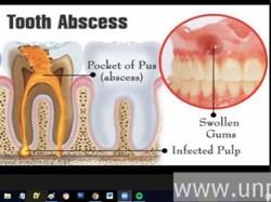 Dosen Unpad Jelaskan Efek Gigi Mati yang Dibiarkan: Infeksi Sampai Hidung