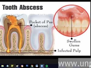 Dosen Unpad Jelaskan Efek Gigi Mati yang Dibiarkan: Infeksi Sampai Hidung Dosen Unpad Jelaskan Efek Gigi Mati yang Dibiarkan: Infeksi Sampai Hidung