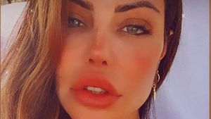 Foto Before After Bibir Model Brazil yang Dioperasi karena Keracunan Filler