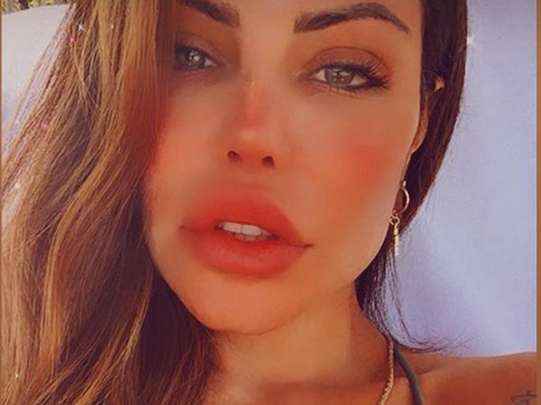 Foto Before After Bibir Model Brazil yang Dioperasi karena Keracunan Filler