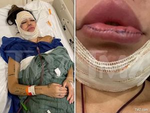 Model Dilarikan ke RS, Hampir Meninggal karena Keracunan Filler Model Dilarikan ke RS, Hampir Meninggal karena Keracunan Filler