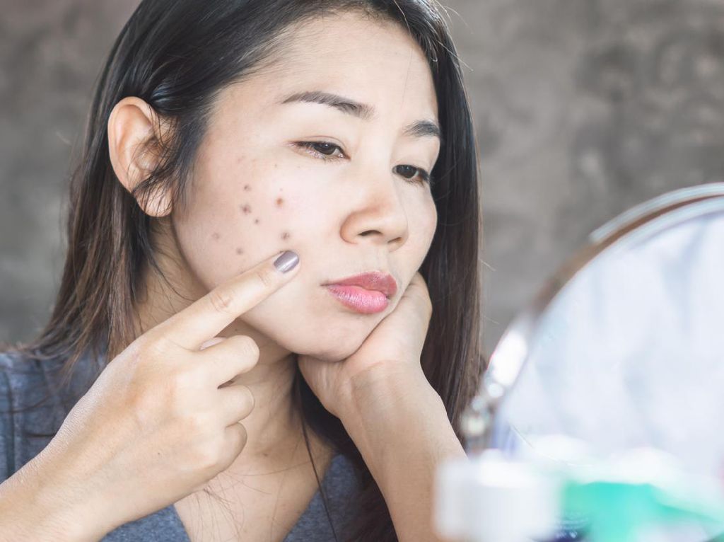 8 Cara Menghilangkan Noda Hitam Bekas Jerawat Pakai Skincare Hingga Alami