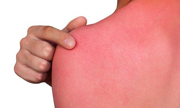 Lidah buaya bisa membantu mengobati kulit yang terbakar sinar matahari