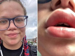 Miris! Wajah Wanita Ini Bengkak karena Saus Tomat pada Pizza