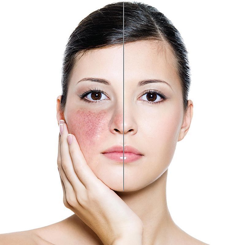 Kebiasaan penyebab rosacea/