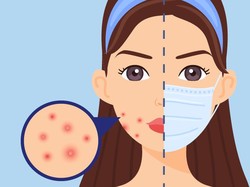 Simak! Ini 5 Cara Mencegah Jerawat Akibat Terus Pakai Masker