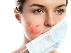 Jerawat Kistik, Penyebab dan Cara Mengobatinya