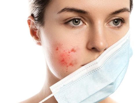 Bermasker Bikin Jerawat