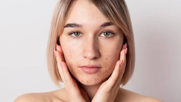 acne skin / foto : freepik