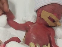 Setelah 13 Bulan di RS, Bayi Terkecil di Dunia Akhirnya Boleh Pulang