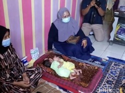 Tolong! Bayi Kembar Siam di Sukabumi Butuh Uluran Tangan