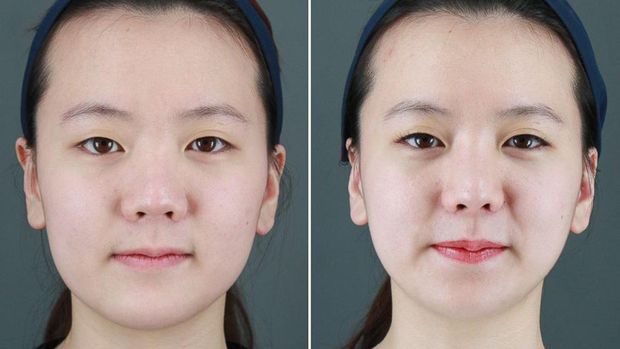 Operasi plastik di Korea