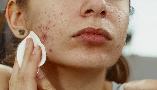 kulit sensiitif, tipe kulit sensitif