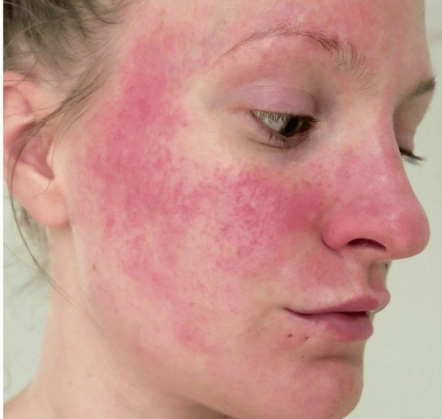 kulit sensitif, tipe kulit sensitif