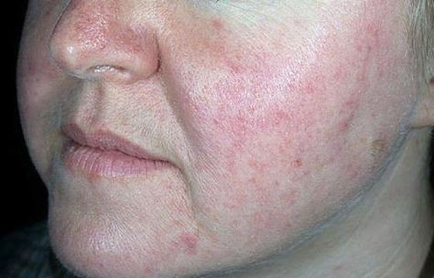 kulit sensitif, tipe kulit sensitif