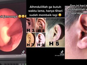 Ngeri! Jamur Tumbuh di Kuping Pria Ini Karena Keseringan Pakai Cotton Buds