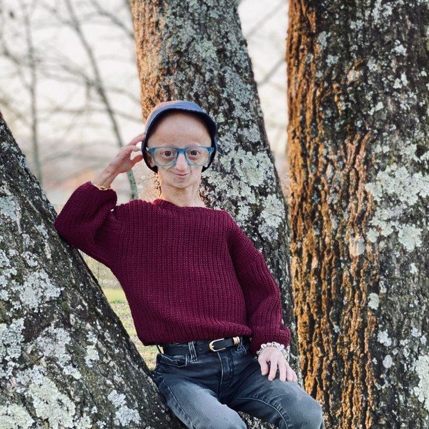 Claudia Amaral, pengidap progeria / Foto : instagram.com/claudiiaamarall Claudia Amaral, pengidap progeria / Foto : instagram.com/claudiiaamarall