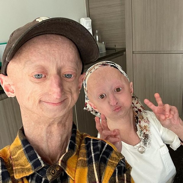 Sosok pengidap penyakit progeria / Foto : instagram.com/michielvandeweert Sosok pengidap penyakit progeria / Foto : instagram.com/michielvandeweert