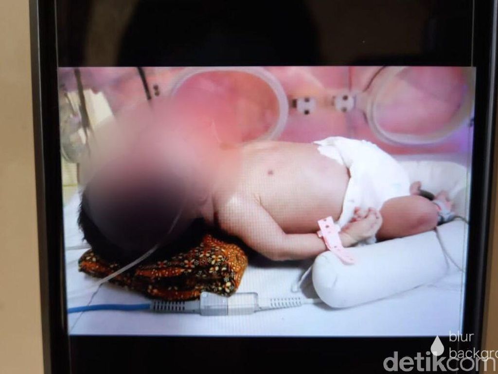 Wanita di Tegal Lahirkan Bayi Kembar Siam, Satu Tubuh Berkepala Dua