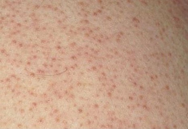 Penampakan keratosis pilaris atau chicken skin/Foto: Pinterest.com/mayoclinic keratosis pilaris
