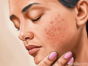 Dibuat Frustasi Acne Shaming