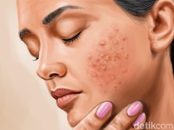 Dibuat Frustasi Acne Shaming