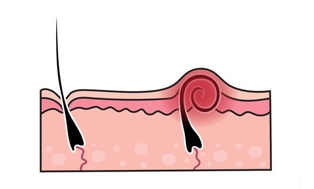 Ilustrasi rambut normal (kiri) dan ingrown hair (kanan)/Foto: Pinterest.com/sjones80 rambut rusak