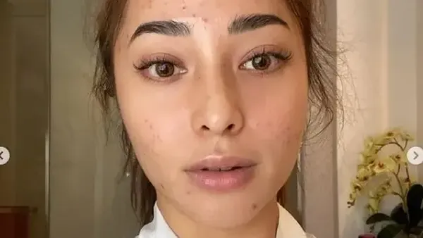 7 Deretan Artis Indonesia Pejuang Jerawat, Nissa Sabyan Wajahnya Diperban