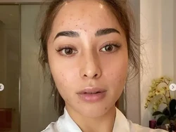 8 Makanan yang Menyebabkan Jerawat, Perlu Dihindari Agar Wajah Mulus