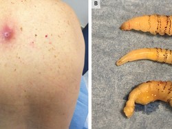 Bentol Dikira Gigitan Nyamuk, Tak Tahunya Ada Parasit di Kulit Wanita Ini