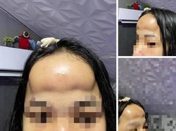 Gagal Cantik, Wanita Ini Mau Implan Dahi Endingnya Malah bak Disengat Lebah
