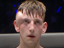 Viral Lagi! Tetap Bertarung meski sudah Benjol Segede Bakpao