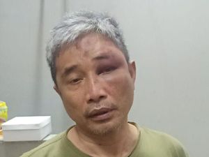 Lebam Seperti Muhammad Kece Usai Dianiaya Napoleon, Sefatal Apa Dampaknya? Lebam Seperti Muhammad Kece Usai Dianiaya Napoleon, Sefatal Apa Dampaknya?