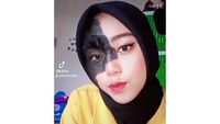 Ini Potret Remaja yang Viral Di-Bully karena Punya Tanda Lahir di Wajah