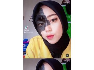 Ini Potret Remaja yang Viral Di-Bully karena Punya Tanda Lahir di Wajah
