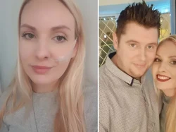 Awalnya Tersedak, Wanita Ini Alami Penyakit Langka dan Harus Makan Lewat Selang