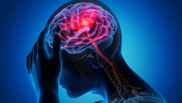 Ilustrasi Pendarahan Otak Medical illustration of a brain with stroke symptoms