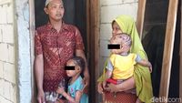 Kulit Pecah-Bersisik Sekujur Tubuh, Dua Bocah di Boyolali Idap Kelainan Langka
