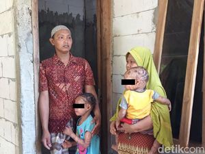 Kulit Pecah-Bersisik Sekujur Tubuh, Dua Bocah di Boyolali Idap Kelainan Langka Kulit Pecah-Bersisik Sekujur Tubuh, Dua Bocah di Boyolali Idap Kelainan Langka