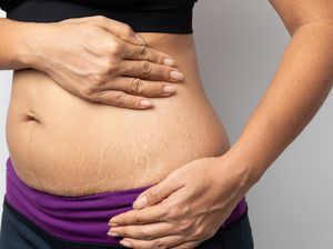 5 Penyebab Stretch Mark di Paha dan Cara Menyamarkannya 5 Penyebab Stretch Mark di Paha dan Cara Menyamarkannya