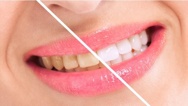 Breaching teatment, woman perfect whiten teeth close up