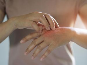 7 Obat Biduran Alami yang Mudah Ditemui, dari Lidah Buaya hingga Kunyit 7 Obat Biduran Alami yang Mudah Ditemui, dari Lidah Buaya hingga Kunyit